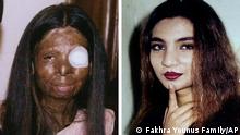Pakistani acid victim Fakhra Younus