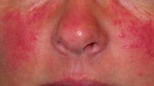 اعراضها احمرار في المنطقة الوسطى من الوجه ( الأنف والخدين