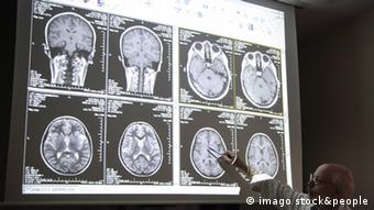 Μελέτη του τραυλισμού με τη βοήθεια μαγνητικών τομογραφιών του εγκεφάλου 