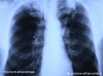 Ακτινογραφία πνευμόνων που έχουν προσβληθεί από φυματίωση