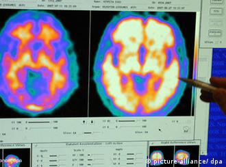 Snimke mozga - zdravog i oboljelog od Alzheimera 